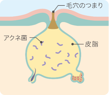 白ニキビ・黒ニキビイメージ