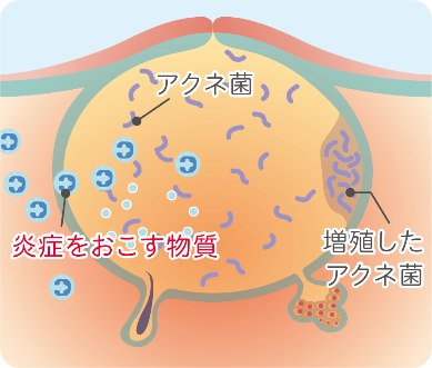 赤ニキビ・黄ニキビイメージ